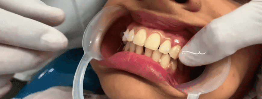 can invisalign fix overbite without rubber bands