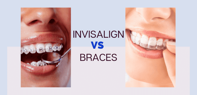 invisalign vs braces which is faster