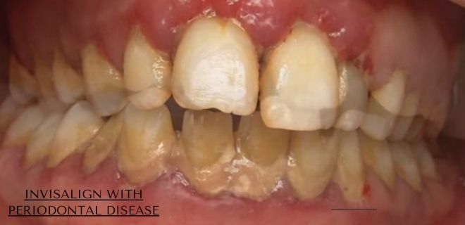 teeth straightening after gum disease