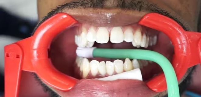 invisalign attachments glue all over teeth