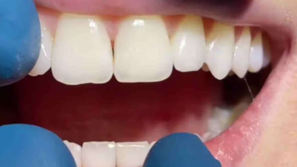 what are black triangles with invisalign