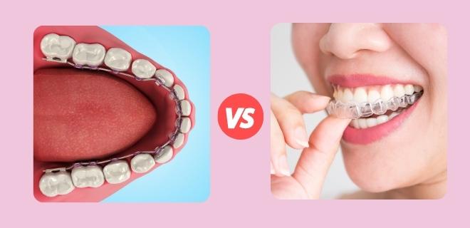 Lingual Braces vs. Invisalign: Which is the Best?