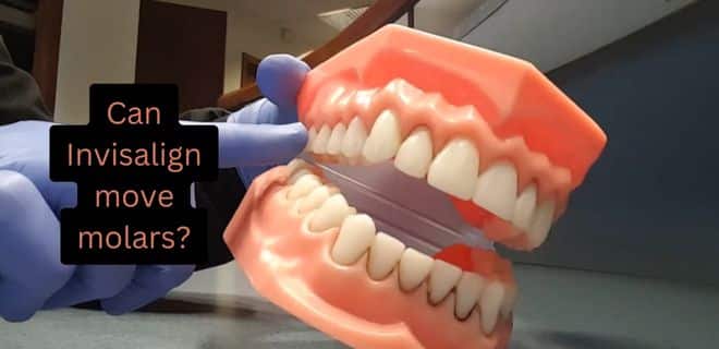 Can Invisalign move molars