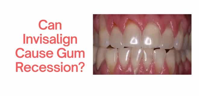 Can Invisalign Cause Gum Recession