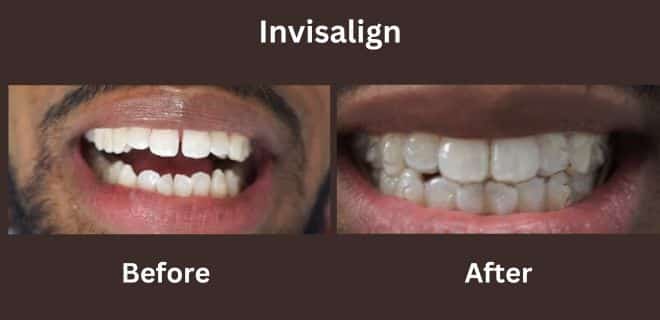 invisalign Before and after